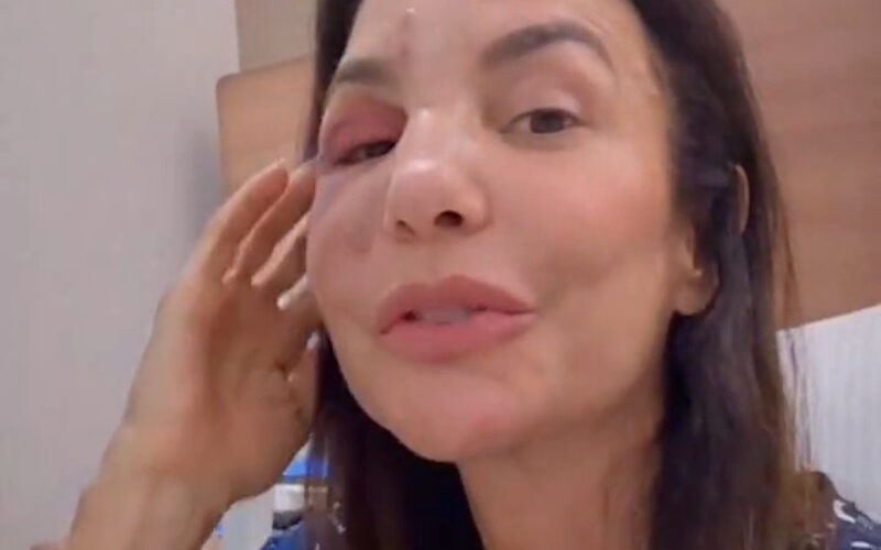 Ivete Sangalo compartilha experiência de cirurgia facial após incidente grave